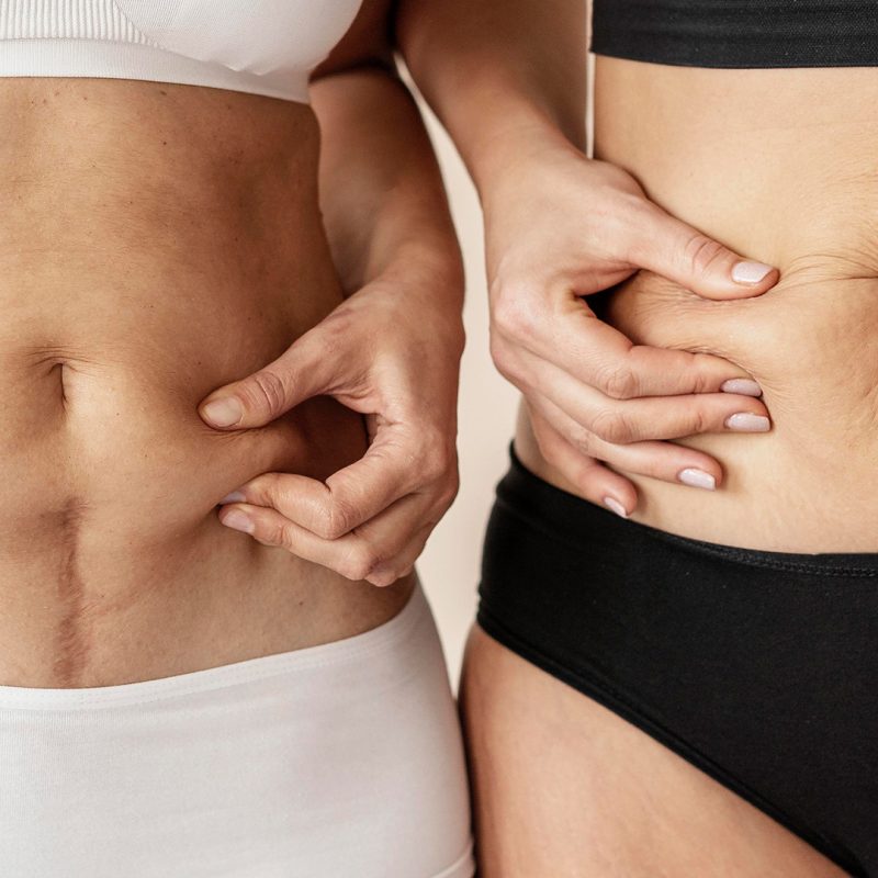 Differences Between Gastric Sleeve Gastrectomy and Gastric Bypass